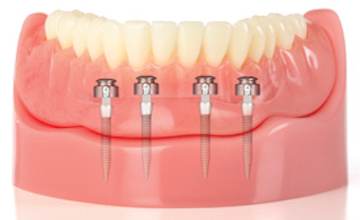 Mini Dental Implants: | Best Dental in Houston, TX