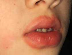red bump on my lip