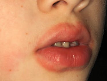 Oral exam: damage by sucking | Dental Hygienists