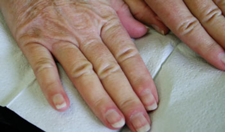 Image result for Raynaud’s Syndrome