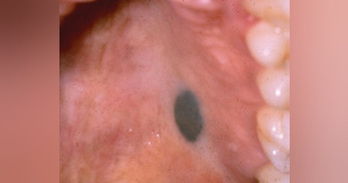 The Blue Nevus or Malignant Melanoma? | Registered Dental Hygienists