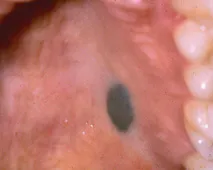 oral melanotic macule roof of mouth Pigmented on the mandibular gingiva (a, case 1), affecting the Intra oral photograph of the