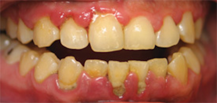 Hydrogen Peroxide In Dentistry Registered Dental Hygienist Rdh Magazine,Cat Colors Pictures