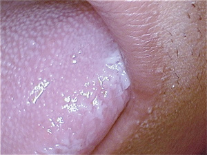 Tongue chewing | Registered Dental Hygienist (RDH) Magazine Tongue chewing | Registered Dental Hygienist (RDH) Magazine