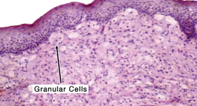 Tongue Granular Cell Tumor Registered Dental Hygienist RDH Magazine tongue-granular-cell-tumor-registered-dental-hygienist-rdh-magazine