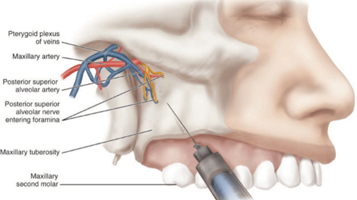 Local Anesthesia Options During Dental Hygiene Care - 