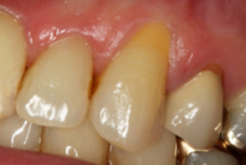 An innovative way to relieve dentinal hypersensitivity Registered