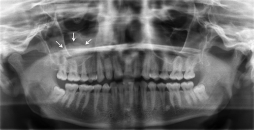 Antral Pseudocyst Registered Dental Hygienist Rdh Magazine