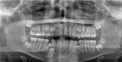 1412rdhcbur Supernum Teeth2 20 1 1412rdhcbur Supernum Teeth2 20 1