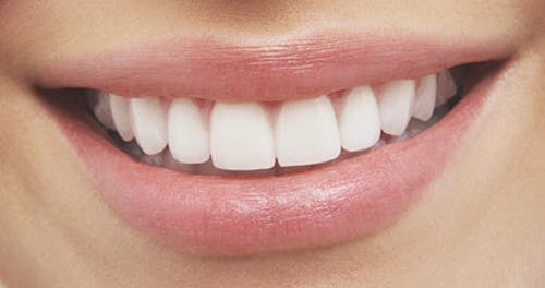 White teeth, the professional way | Registered Dental Hygienists