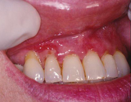 Oral Pemphigus And Pemphigoid: Why Are These Conditions So Hard To ...