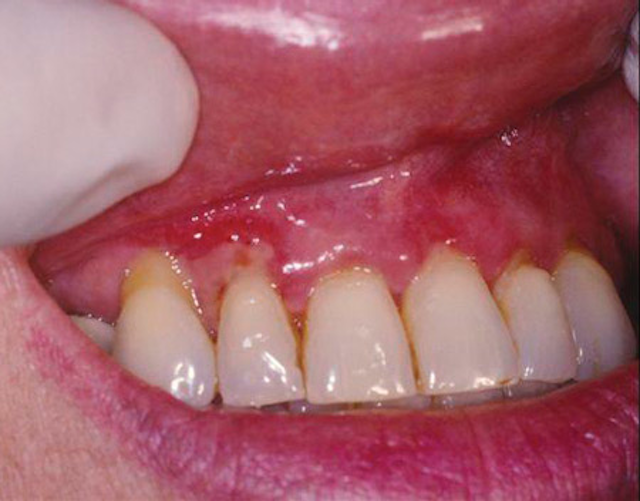 Oral Pemphigus and Pemphigoid: Why are these conditions so hard to ...