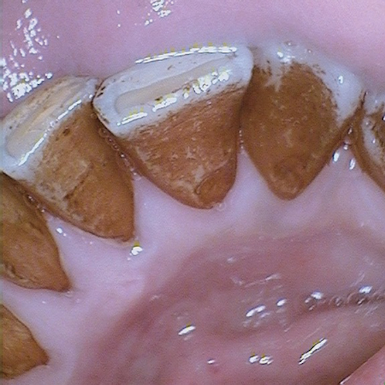 Reduction of Tooth Stains Patient education is vital to preventing