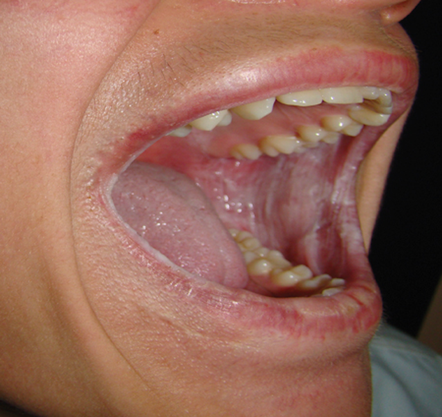 White sponge nevus Registered Dental Hygenist (RDH) Magazine