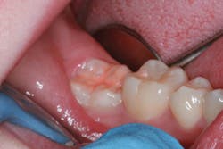 5 Completed Sealant 5 Completed Sealant