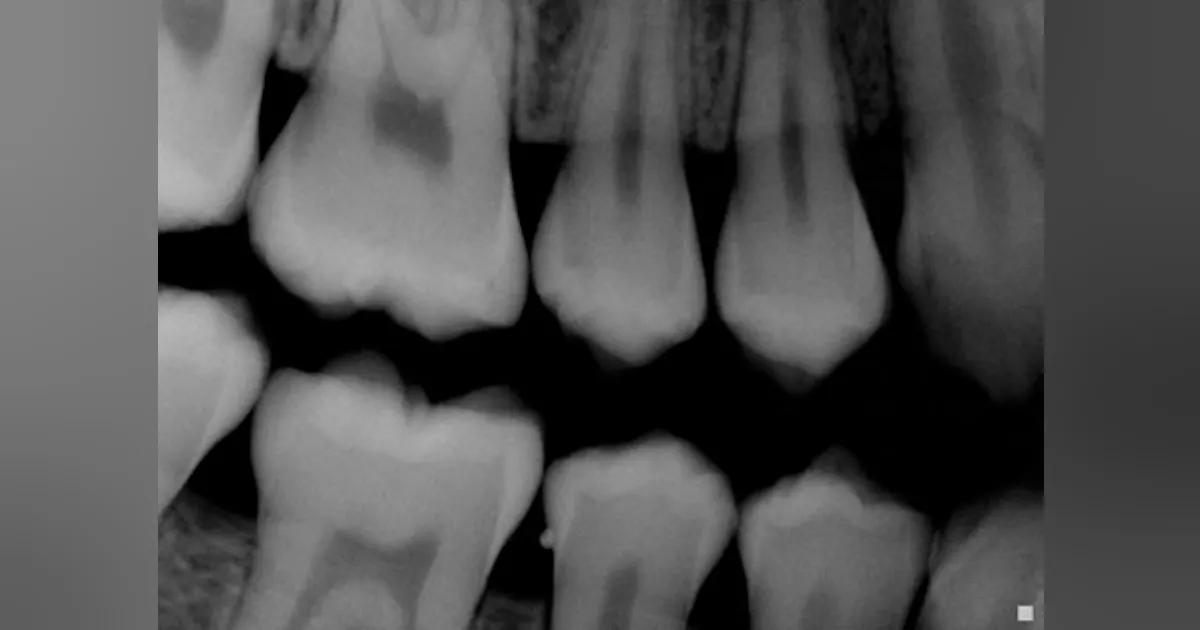 Enamel Projection Cervical Enamel Projection