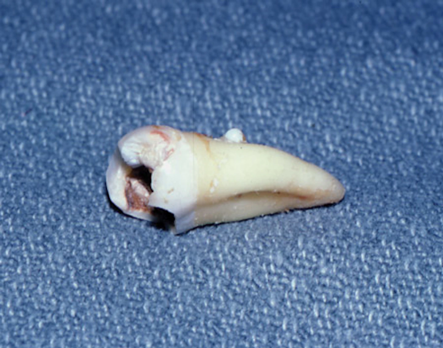 The elusive enamel pearl | Registered Dental Hygienist (RDH) Magazine
