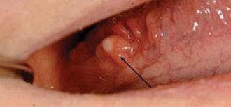 Oral Lymphoepithelial Cyst | Registered Dental Hygienist (RDH) Magazine Oral Lymphoepithelial Cyst | Registered Dental Hygienist (RDH) Magazine