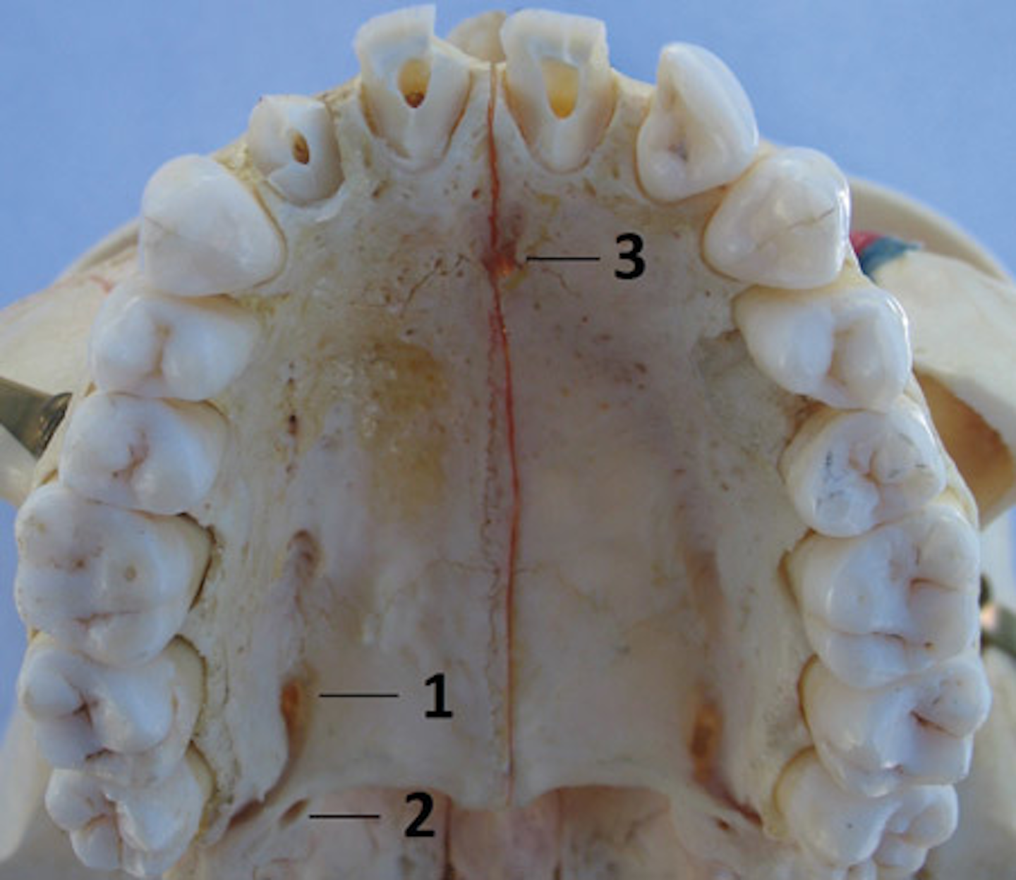 Anesthesia during perio: Maxillary injections useful for adult ...