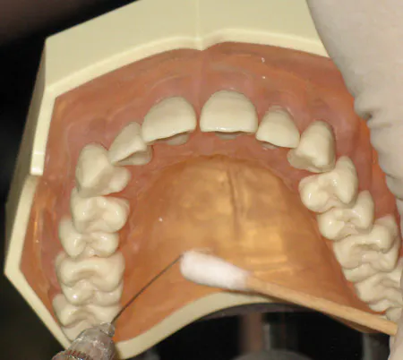 Anesthesia during perio: Maxillary injections useful for adult ...