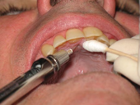 Anesthesia during perio: Maxillary injections useful for adult ...