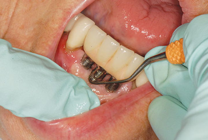 Fig 1 Implant Maintenance On Fused Prosthetic