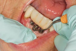 Fig 1 Implant Maintenance On Fused Prosthetic Fig 1 Implant Maintenance On Fused Prosthetic