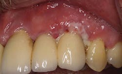 Fig 7 Biofilm Inflammation Fig 7 Biofilm Inflammation