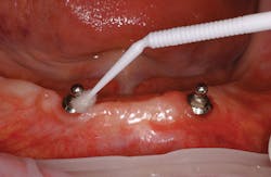 Fig 8 Implant Dr Watzke Ivoclar Vivadent 004 Fig 8 Implant Dr Watzke Ivoclar Vivadent 004