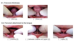 Frenum Infants 3 Frenum Infants 3