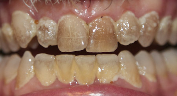 biofilm outsmart dental
