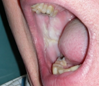 Morsicatio Buccarum Labiorum And Linguarum Registered Dental Hygienists