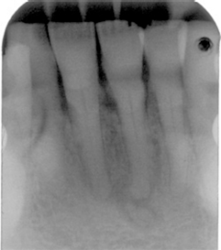 Periapical cemento-osseous dysplasia | Registered Dental Hygienist (RDH ...