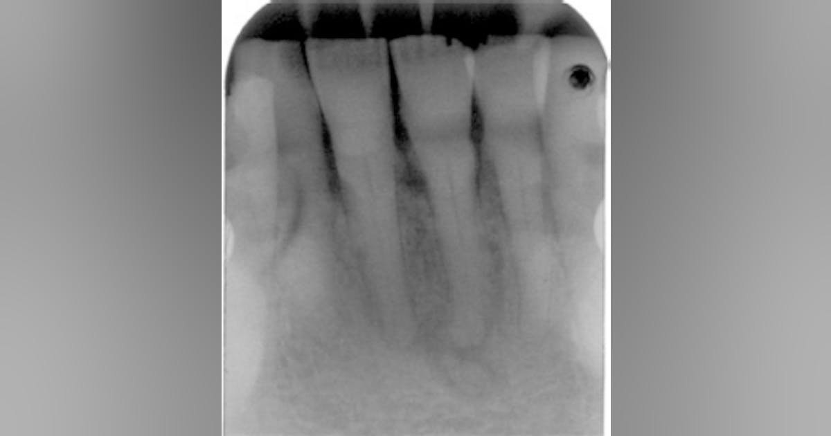 Periapical cemento-osseous dysplasia | Registered Dental Hygienists
