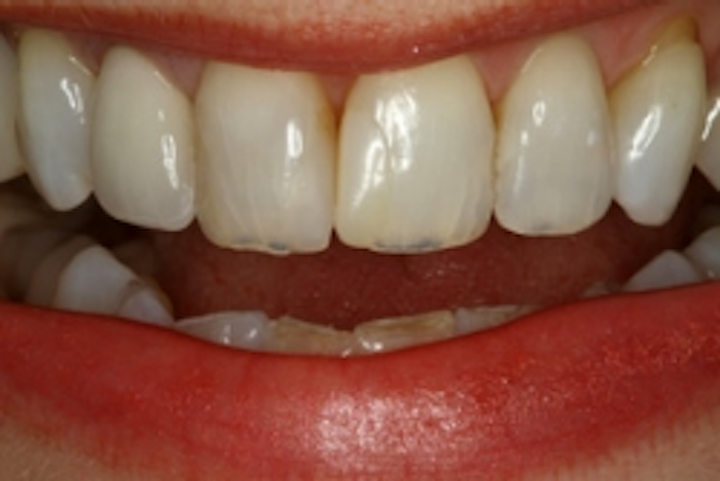 Preventing dental erosion in the pregnant patient | Registered ... Preventing dental erosion in the pregnant patient | Registered ...