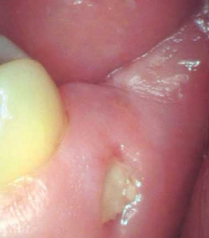 Tooth fragment in gum