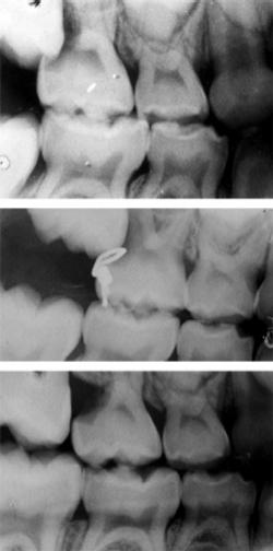 When are bitewings not enough? Registered Dental Hygienists