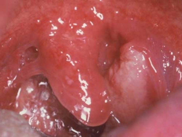 papilloma formái a helminthiasis epidemiológiája