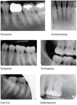 Dental X Ray Angulation Chart