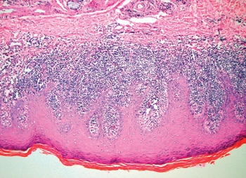 lichen planus histology