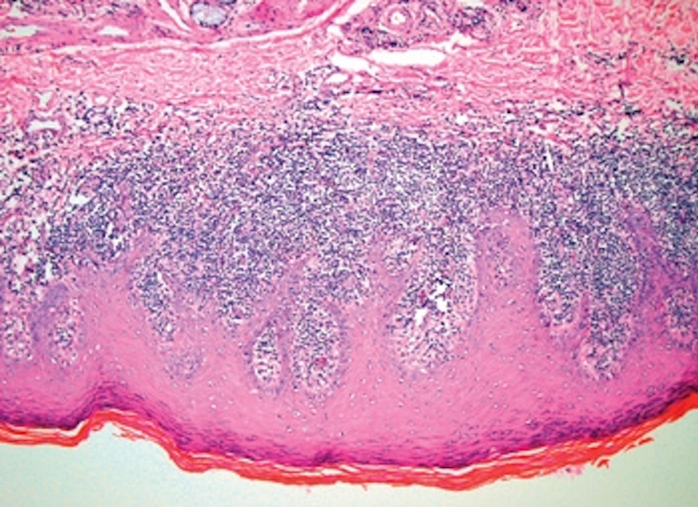Vaginal Lichen Planus Registered Dental Hygienists
