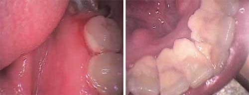 Multi-colour disclosing of dental plaque. Left: clinical image showing