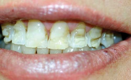 is baking soda bad for gums