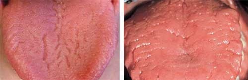 Figure 1: Fissured tongue. Photo at left is courtesy of Alyse Shockey, ND, RDH. Photo at right is courtesy of Dr. Carolyn Bentley.