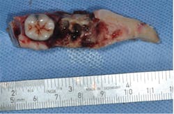 Resected Portion Of Mandibl Resected Portion Of Mandibl