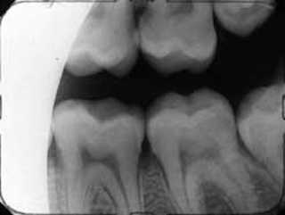 Taking Diagnostic Quality X Rays Registered Dental Hygienists