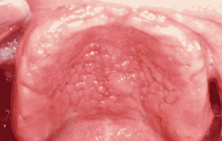 Palatal papillomatosis treatment. Squamous cell directorulweb.ro hpv for throat