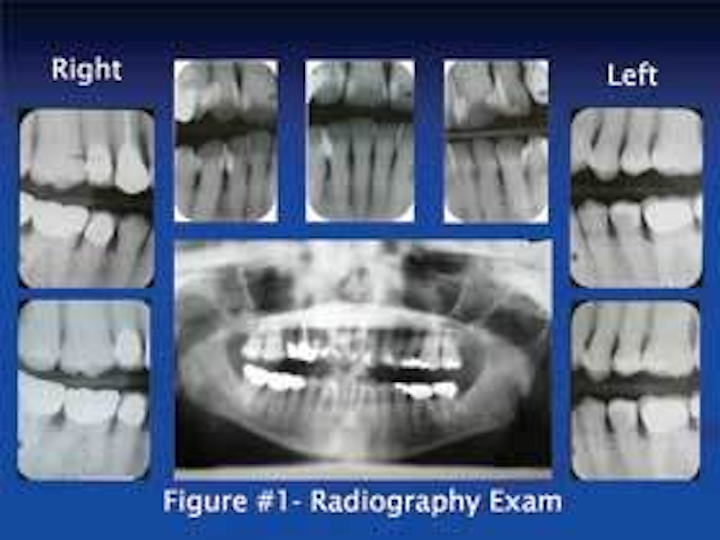 Periodontal Laser Treatment For Gum Disease Cost Procedure Benefit