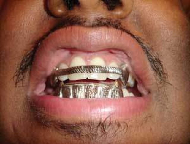 Bling Registered Dental Hygienist - frank marina wears upper and lower grills every day the custom fitted mouth jewelry snaps in place like a bleaching tray