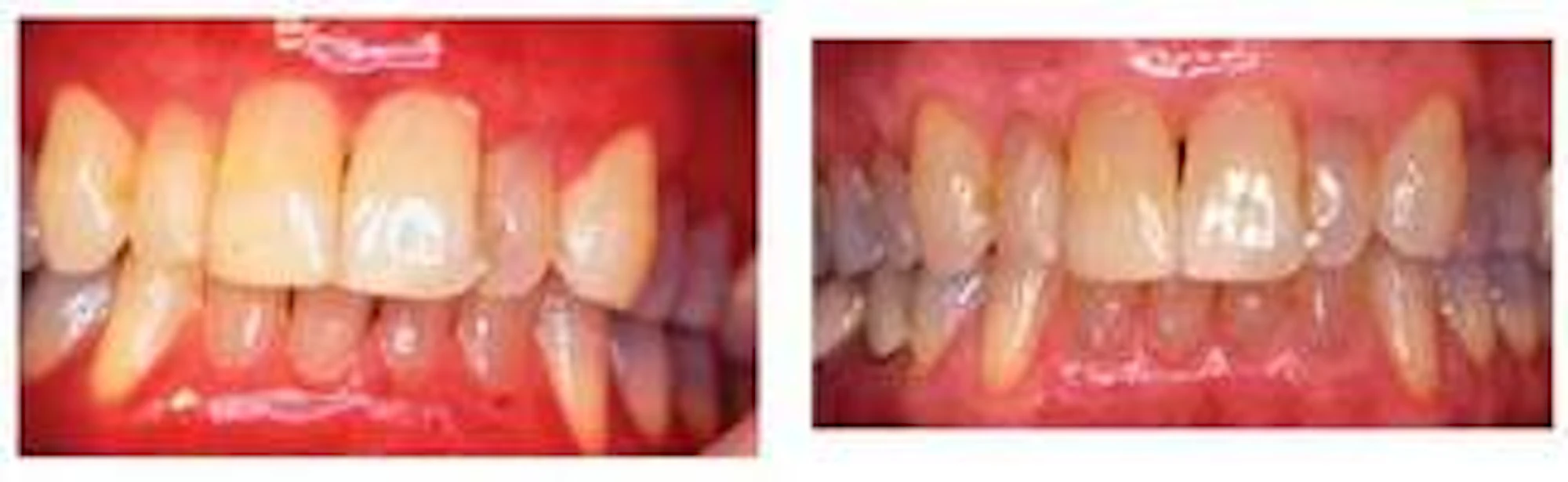 Slurring Toothpaste Toothpaste allergy | Registered Dental Hygienists